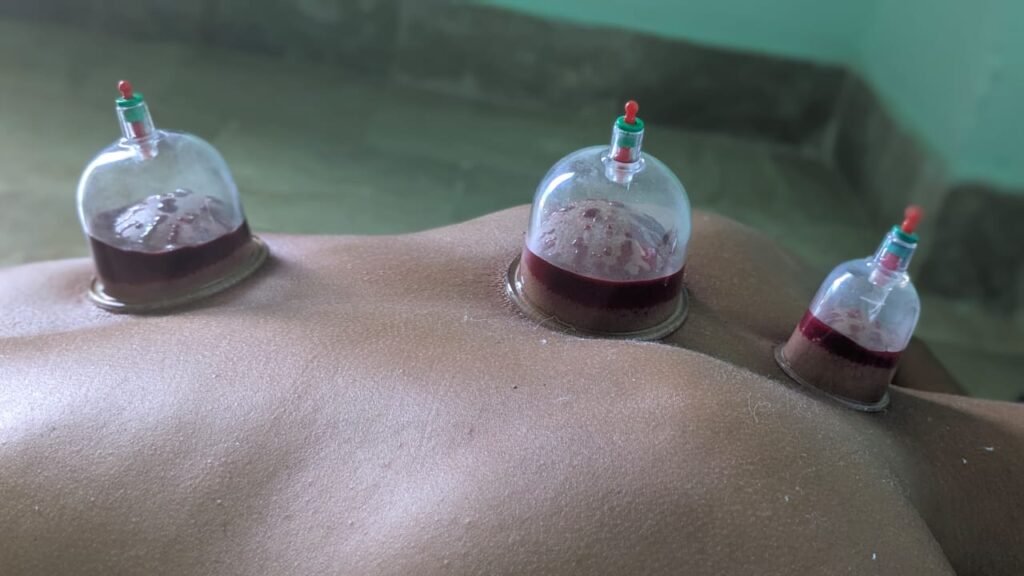 Hijama therapy (wet cupping) at your door step: 1 Physiotheraphy Services in KArachi
